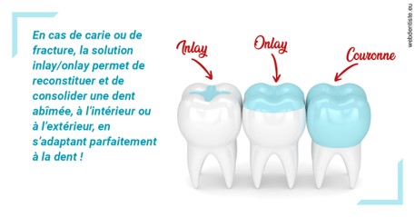 https://www.dr-quentel.fr/L'INLAY ou l'ONLAY