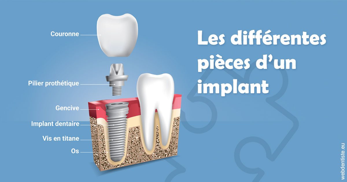 https://www.dr-quentel.fr/Les différentes pièces d’un implant 1